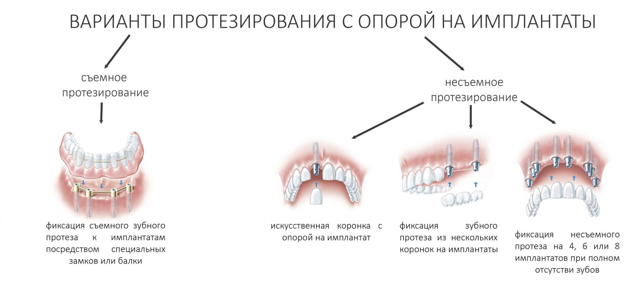 Коронка на передний зуб схема
