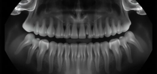 Прицельный снимок зуба: что это, как сделать и на что обратить внимание