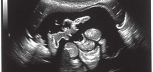 УЗИ матки и яичников: как подготовиться, что покажет и когда не стоит переживать