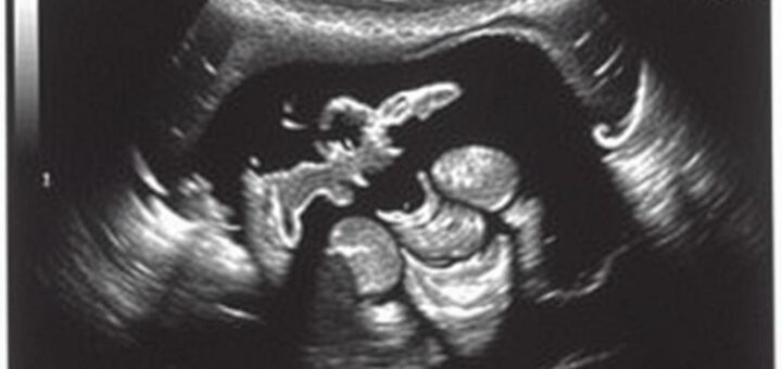 УЗИ матки и яичников: как подготовиться, что покажет и когда не стоит переживать